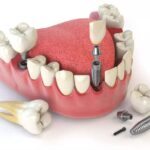 implant dental prosthesis